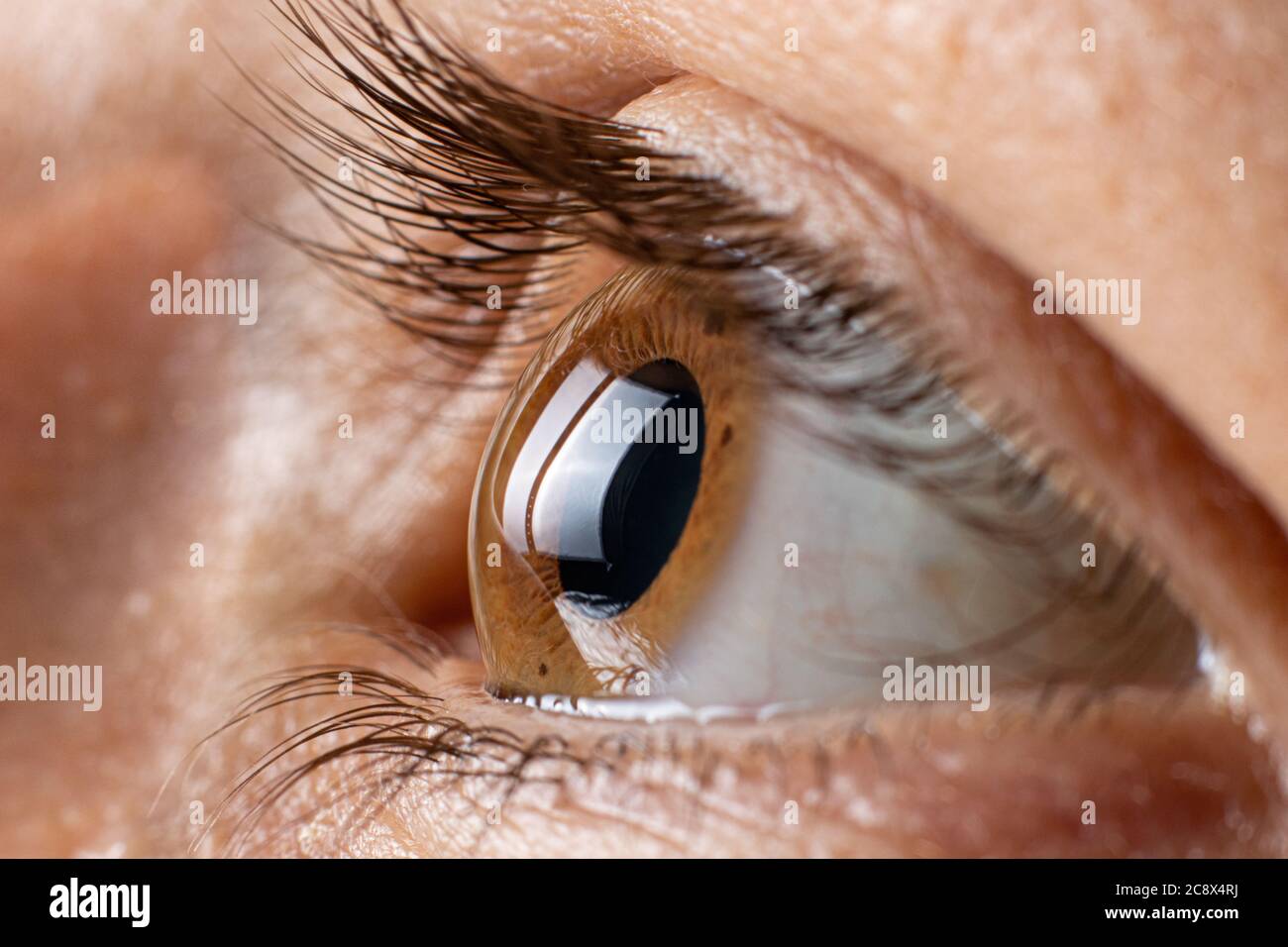 Keratoconus of eye, 3th degree. Contortion of the cornea in the form of a cone, deterioration of vision, astigmatism. Macro close up. Stock Photo