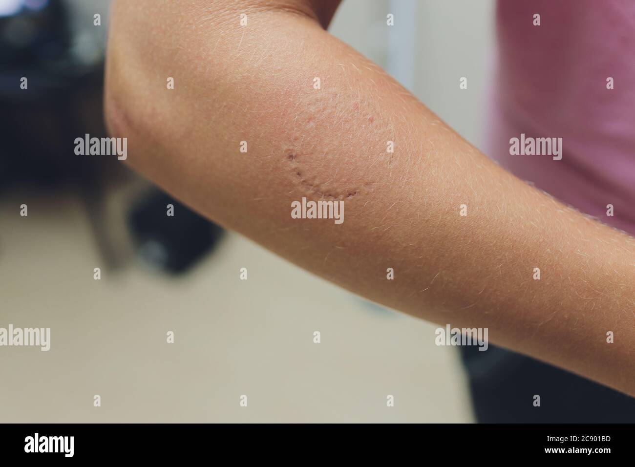 Toddler's bite marks on mothers arm aggressive toddlers behavior