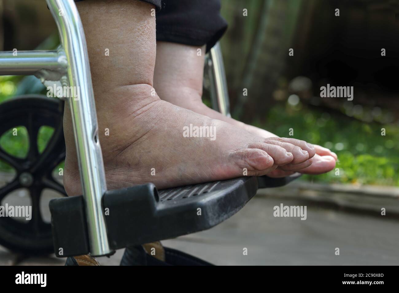Elderly woman swollen feet press test on wheelchair Stock Photo Alamy