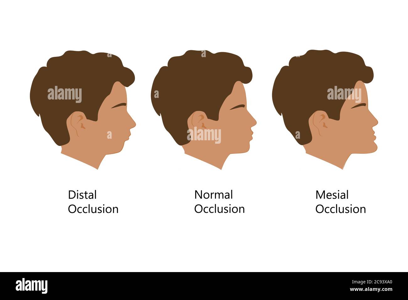 Guy with Distal, Normal, and Mesial bite profile, vector illustration. Overbite or underbite before and after orthodontic treatment. Human with Stock Vector