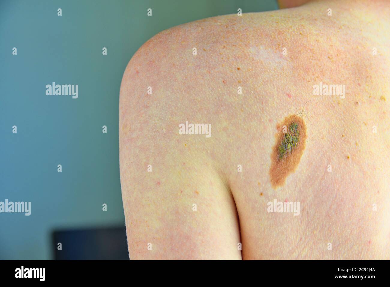 Hairy skin mole. Close up picture of dangerous brown nevus on human skin - melanoma Stock Photo