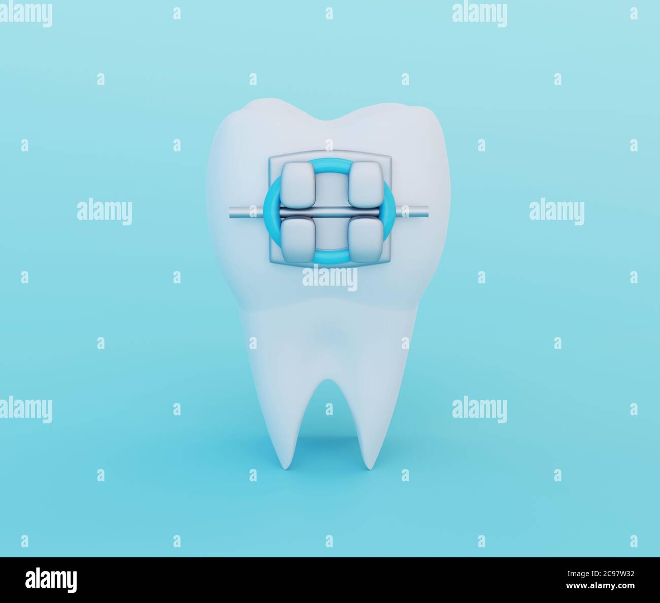 A Tooth with Metal Braces on blue background. Care, Orthodontics and ...