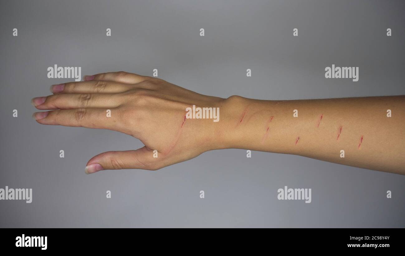 Cat Scratch Disease. A scratched female hand from a cat Stock Photo Alamy