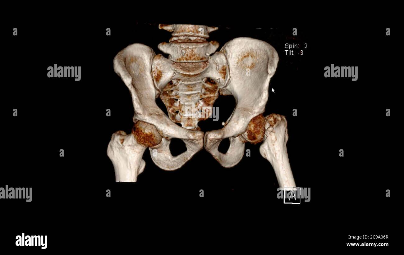 Computed Tomography Volume Rendering examination of the  pelvis showing left femur neck fracture ( CT VR Pelvis). 3D rendering Stock Photo