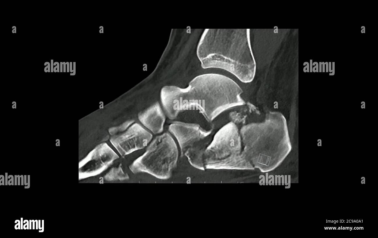 Computed Tomography  of the  foot in sagittal plane showing fracture of  calcaneum/ heel bone ( CT Foot). Stock Photo