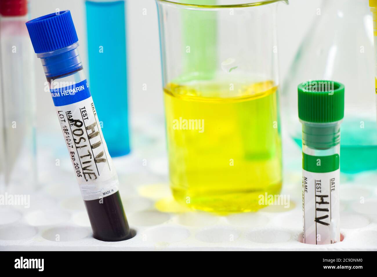 Hiv and aids infection blood test sample, diagnoses and laboratory