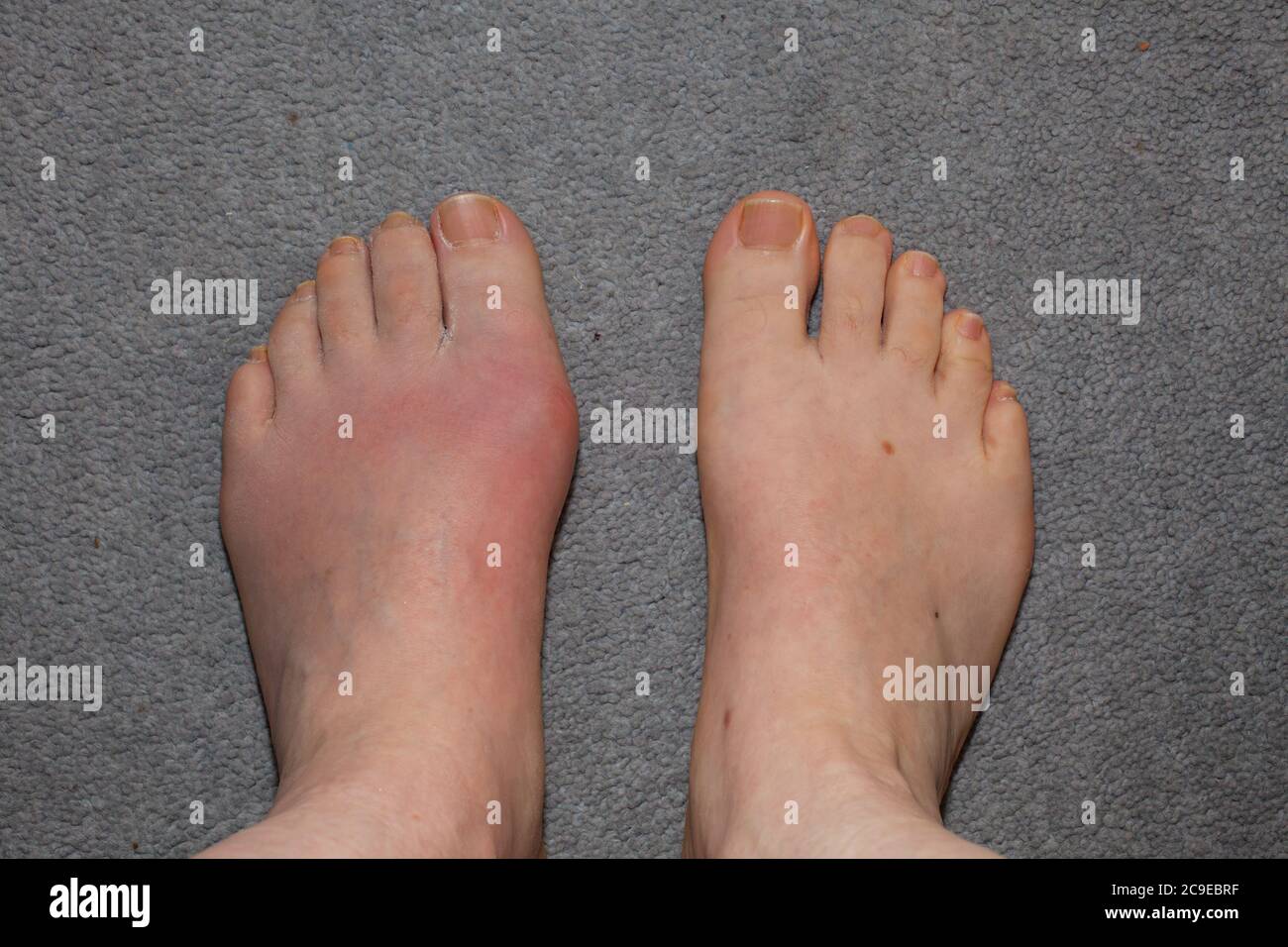 Gouty Toe! One of the most painful and debilitating afflictions