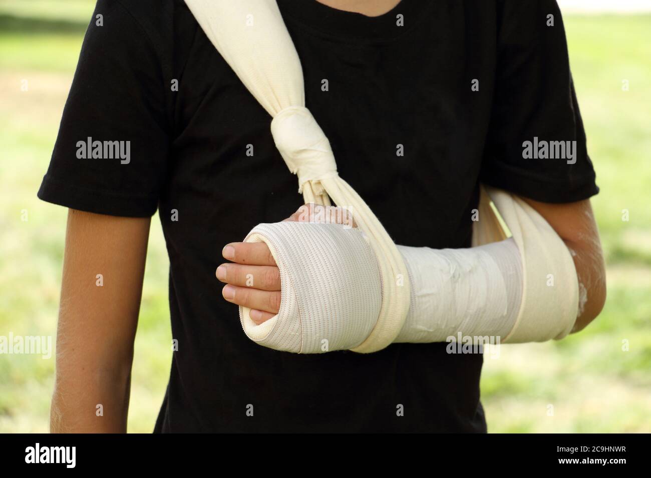 Close up Kid with broken arm and gypsum Stock Photo - Alamy