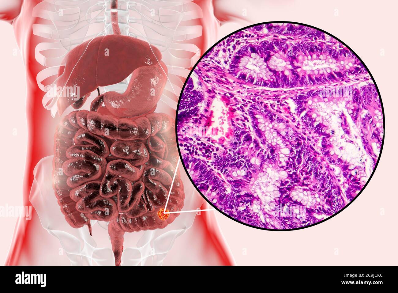 Abnormal colon hires stock photography and images Alamy