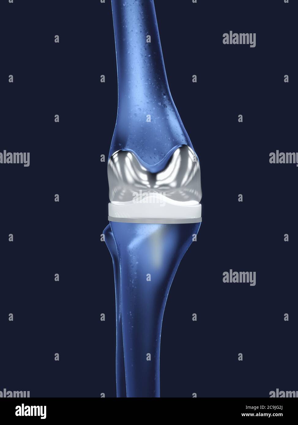 Knee replacement, illustration. Stock Photo