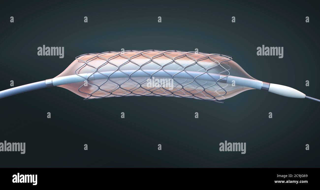 Stent and balloon catheter, illustration Stock Photo Alamy