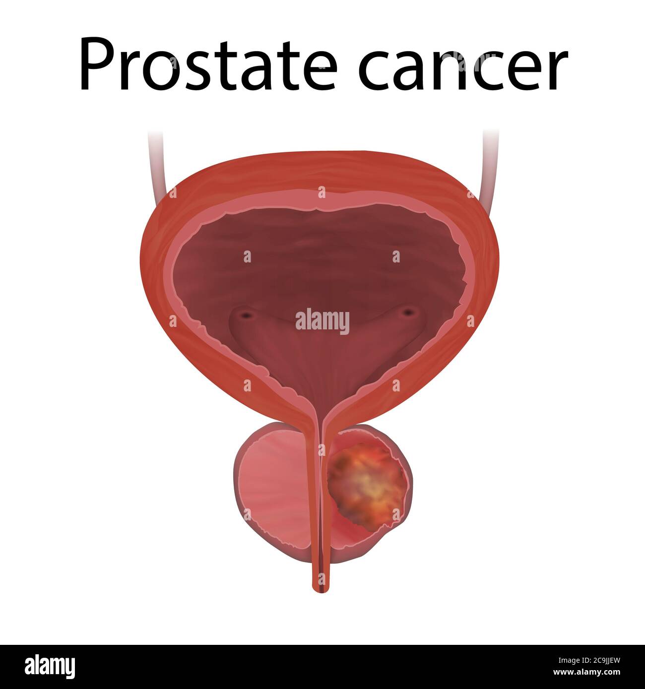 Prostate Cancer Backround Prostate cancer, illustration Stock Photo - Alamy