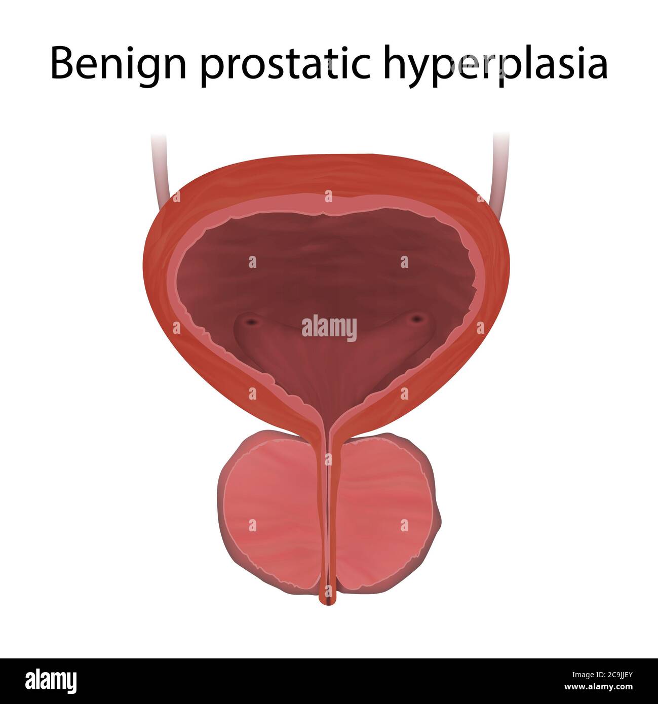 Benign prostatic hyperplasia, illustration. This is a noncancerous