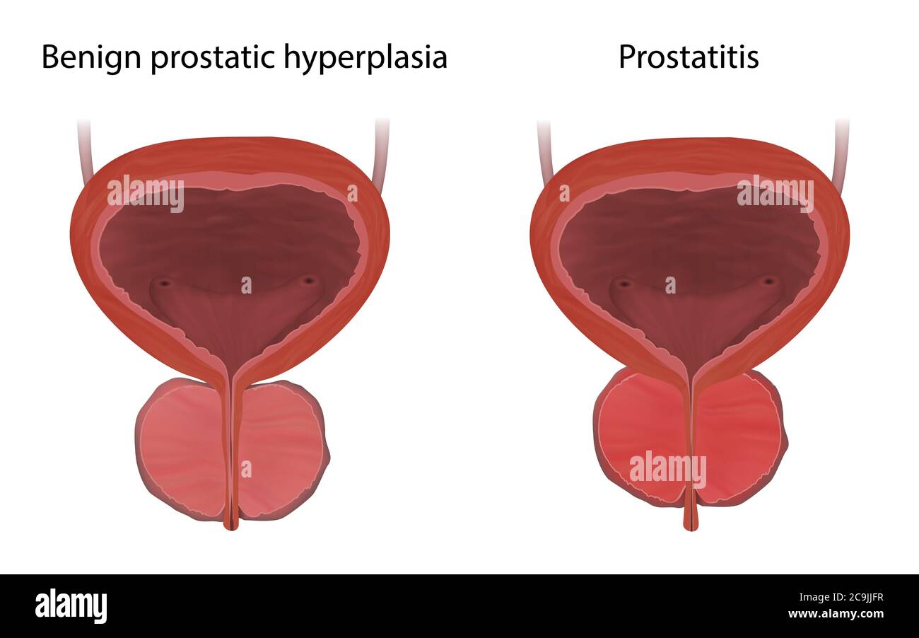 Comparison of benign prostatic hyperplasia and prostatitis