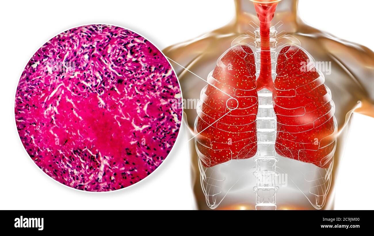 Miliary tuberculosis, computer illustration and light micrograph