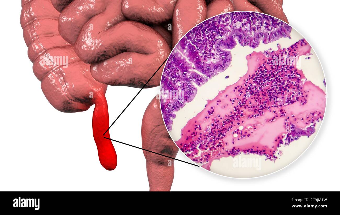 Acute suppurative appendicitis, computer illustration and light ...