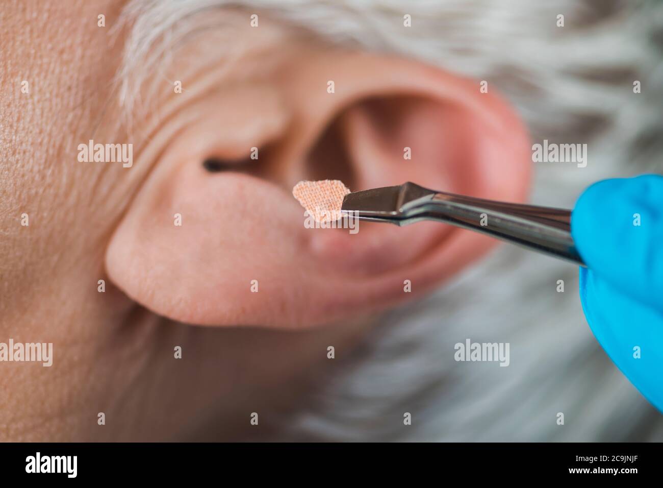 Auriculotherapy, or auricular treatment on human ear, close up