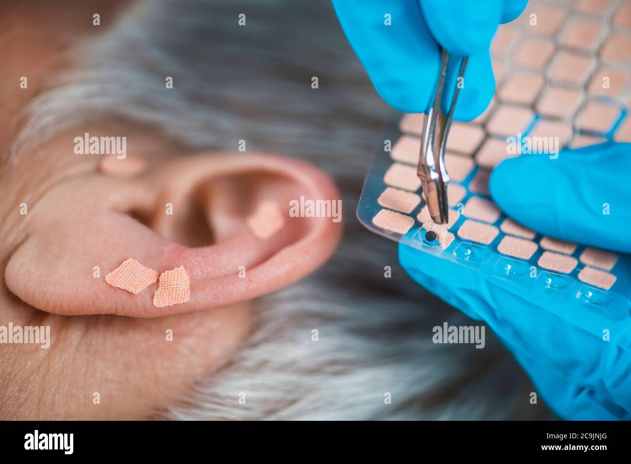 Auriculotherapy, or auricular treatment on human ear, close up