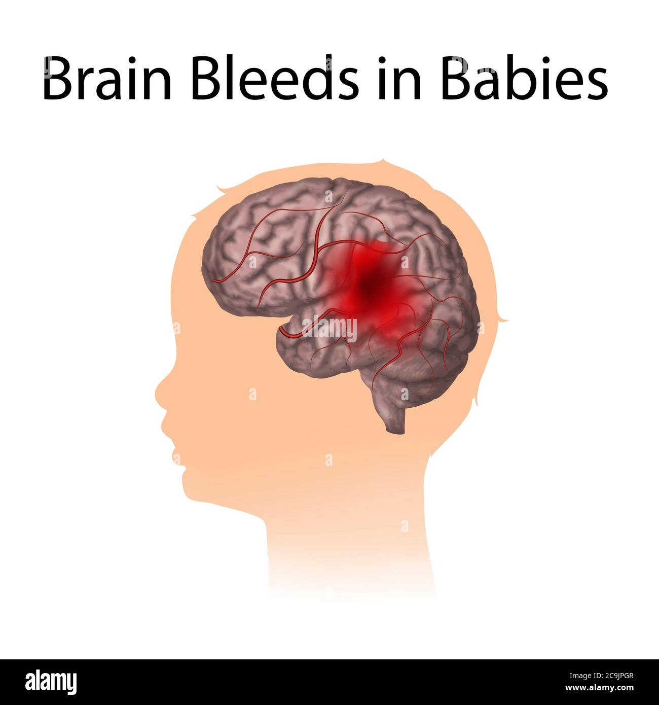 Brain bleeds in babies, illustration. Stock Photo