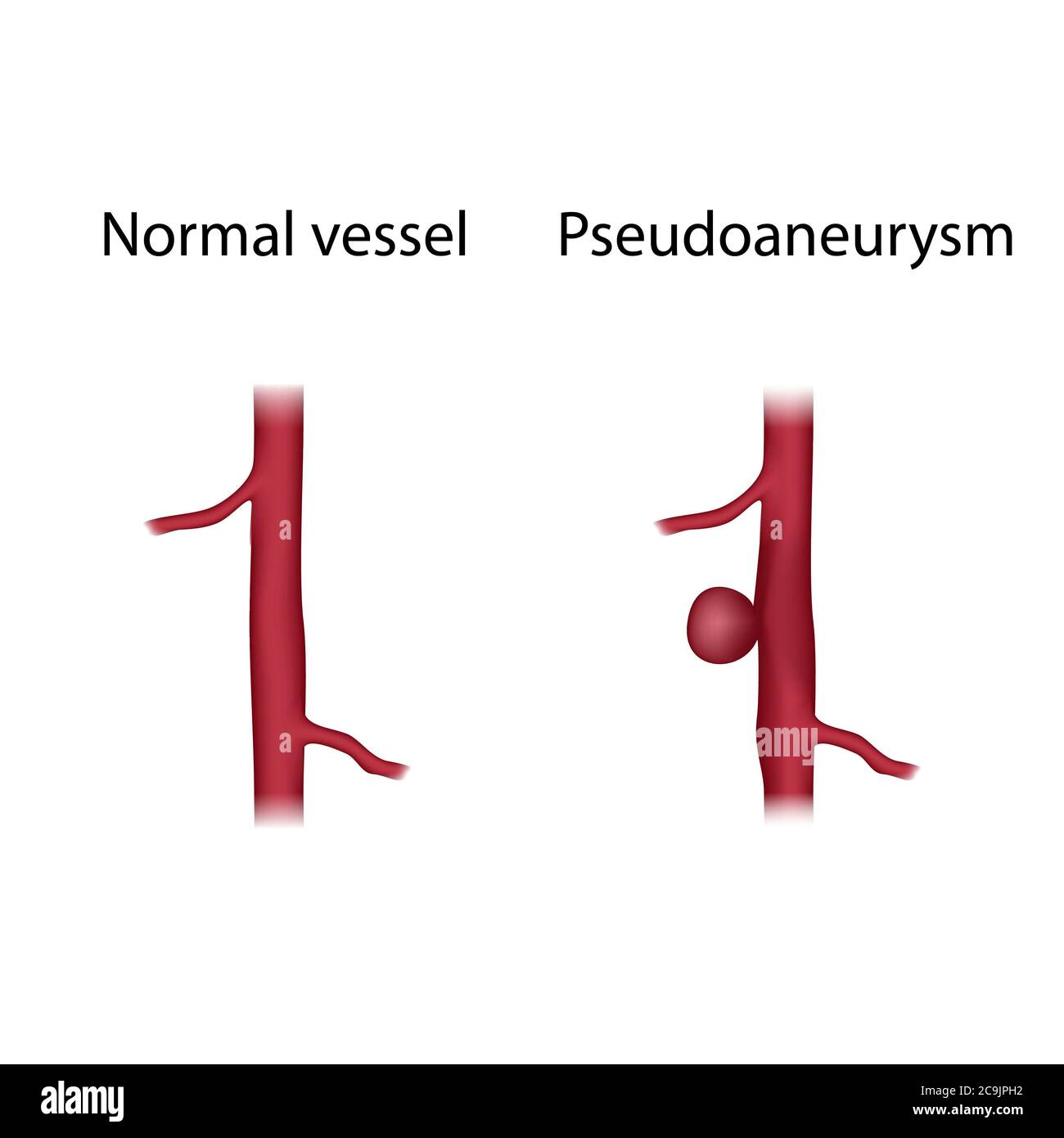 Pseudoaneurysm hi-res stock photography and images - Alamy