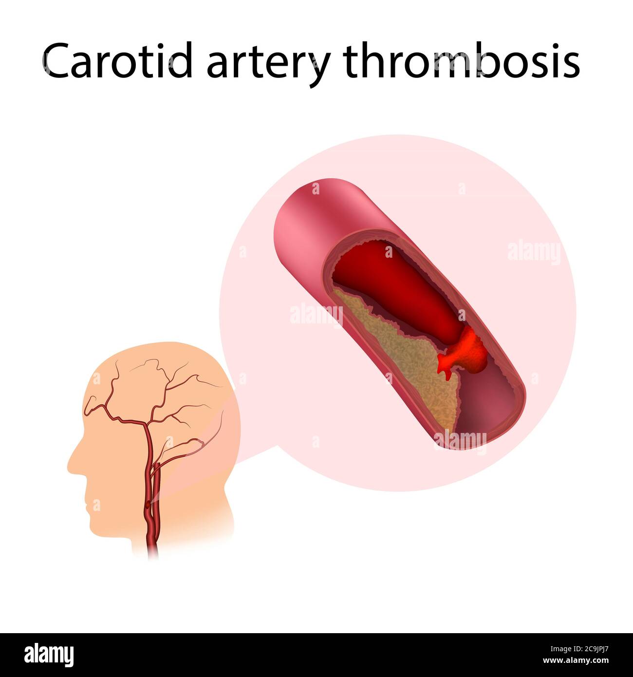 Carotid artery thrombosis, illustration. A blood clot is blocking the blood vessel. Stock Photo