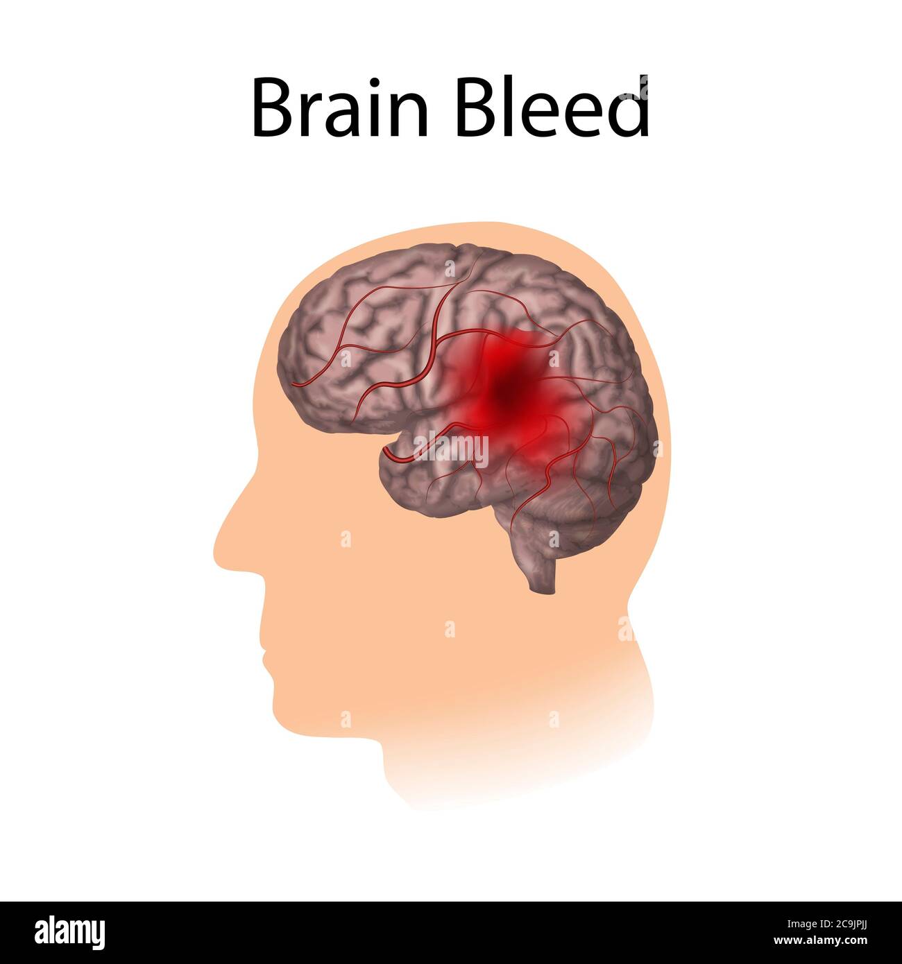 Brain bleed, illustration. Stock Photo