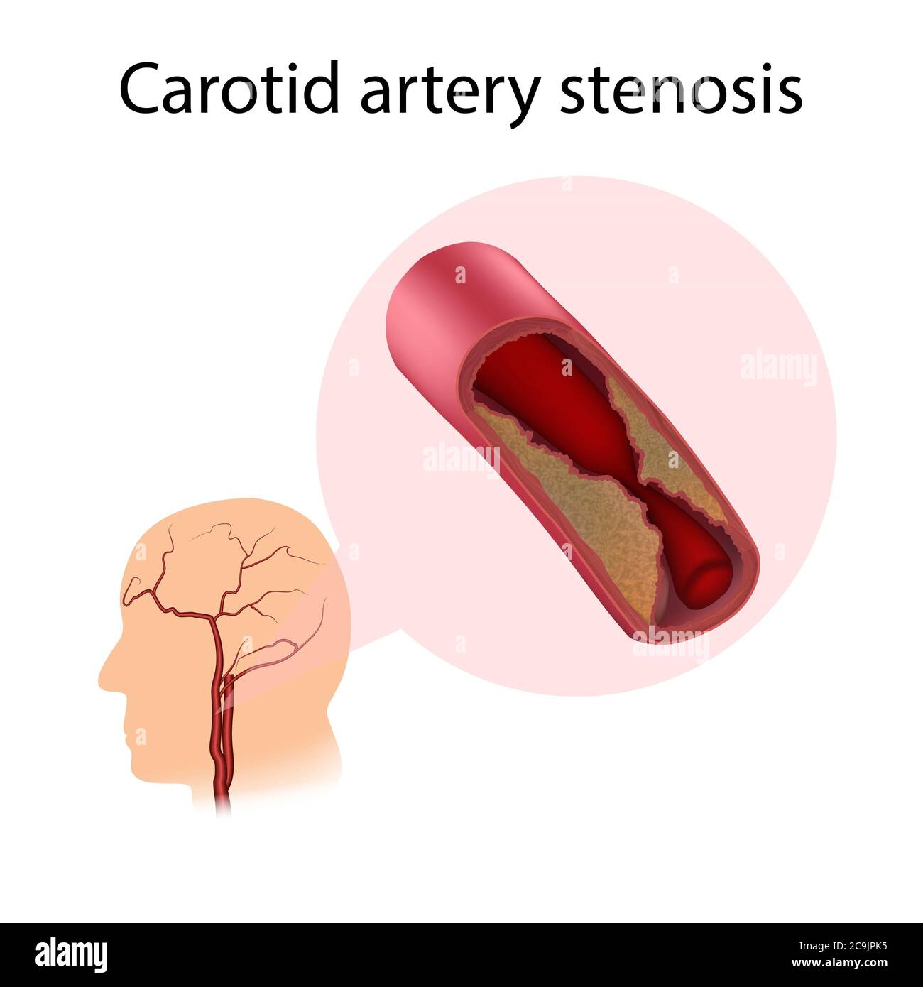 Carotid artery stenosis, illustration. A buildup of plaque is