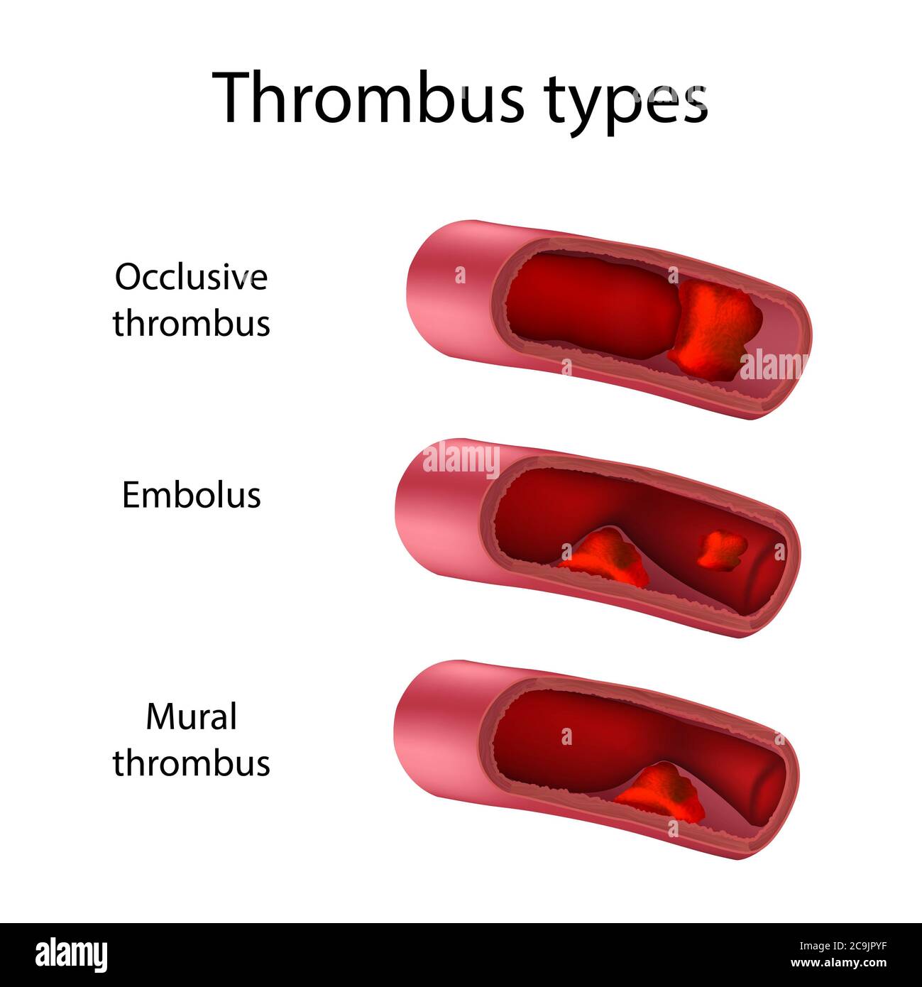 Thrombus types, illustration. Comparison of occlusive, embolus and