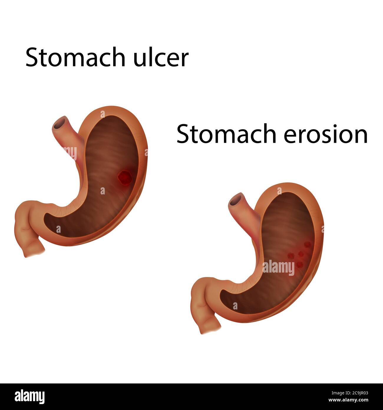 Stomach ulcer and stomach erosion, illustration Stock Photo Alamy