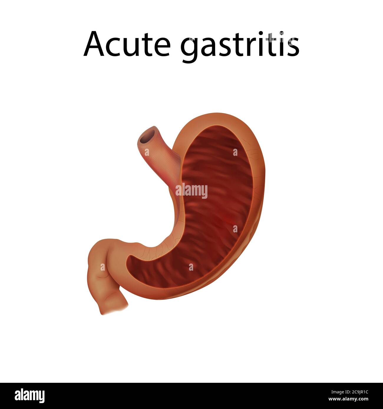 Acute gastritis, illustration Stock Photo Alamy
