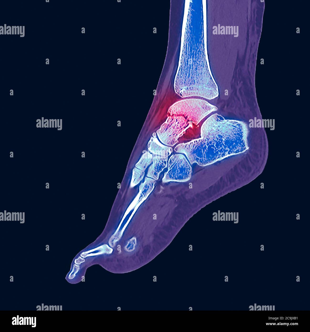 Fractured ankle bone. Coloured computed tomography (CT) scan of the ...