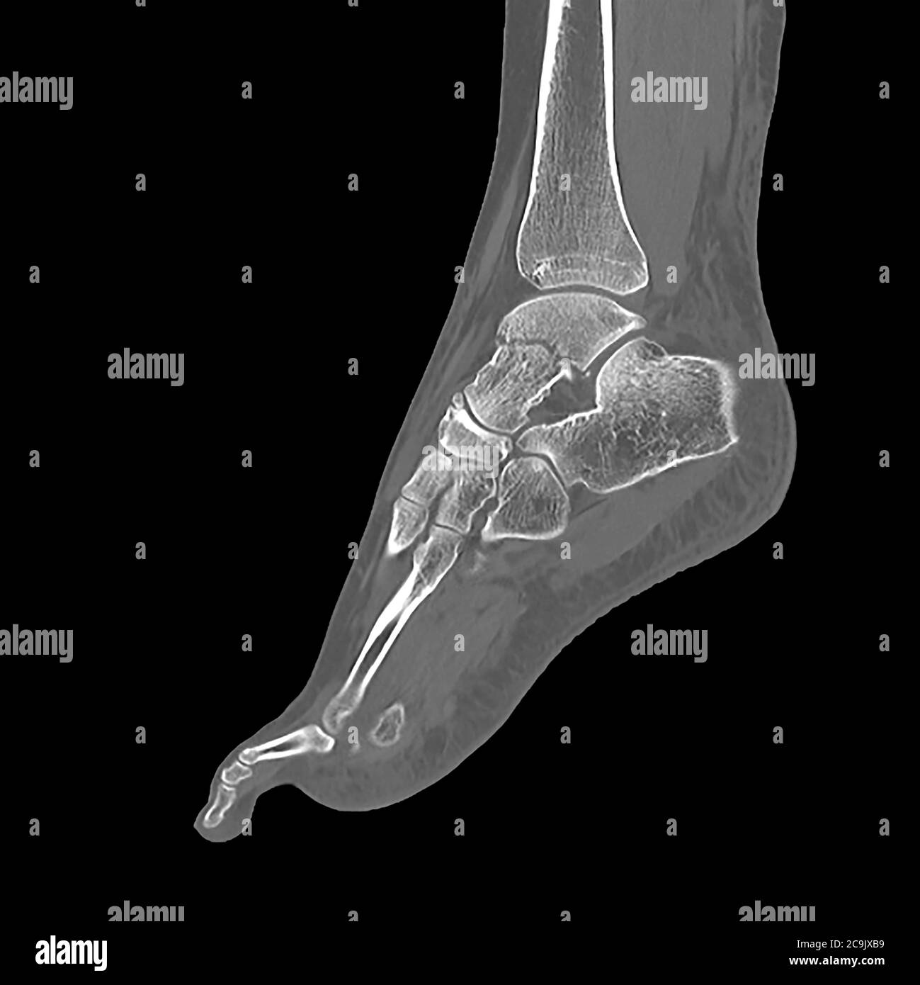 Fractured ankle bone. Computed tomography (CT) scan of the bones of the foot and ankle of a 23-year-old woman with a comminuted (splintered) fracture Stock Photo
