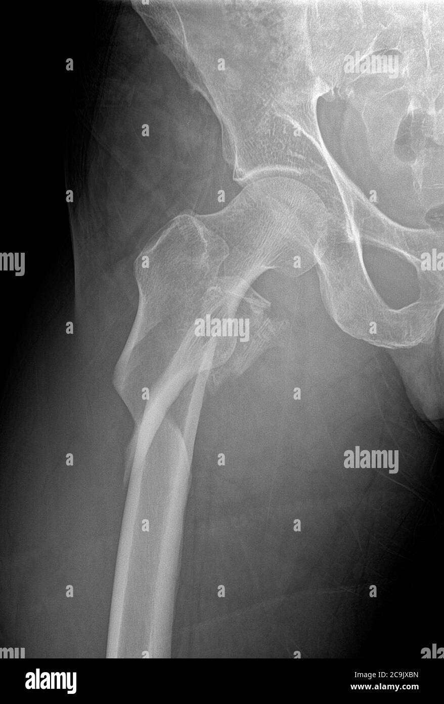 Hip fracture. Frontal X-ray of the right hip of a 53-year-old man, showing a comminuted (splintered) fracture of the neck of the femur (centre left). Stock Photo