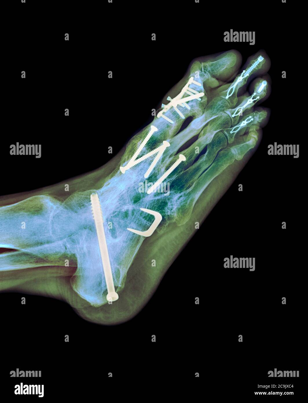 Surgical fixation for rheumatoid arthritis of the feet. Coloured