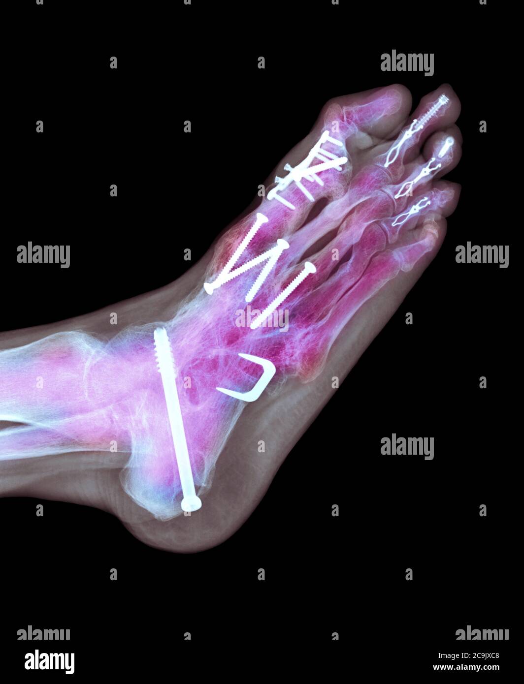 Surgical fixation for rheumatoid arthritis of the feet. Coloured lateral Xray of screws and