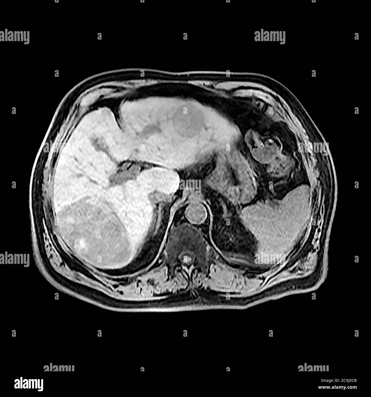Liver cancer. Axial computed tomography (CT) scan through the abdomen of an 80-year-old man with cancer of the liver. The liver is at centre left. The Stock Photo