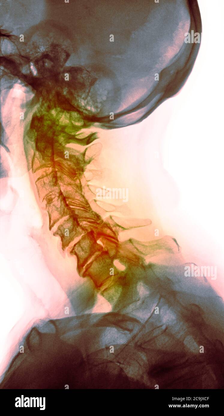 Osteoarthritis of the cervical spine. Coloured lateral Xray of the