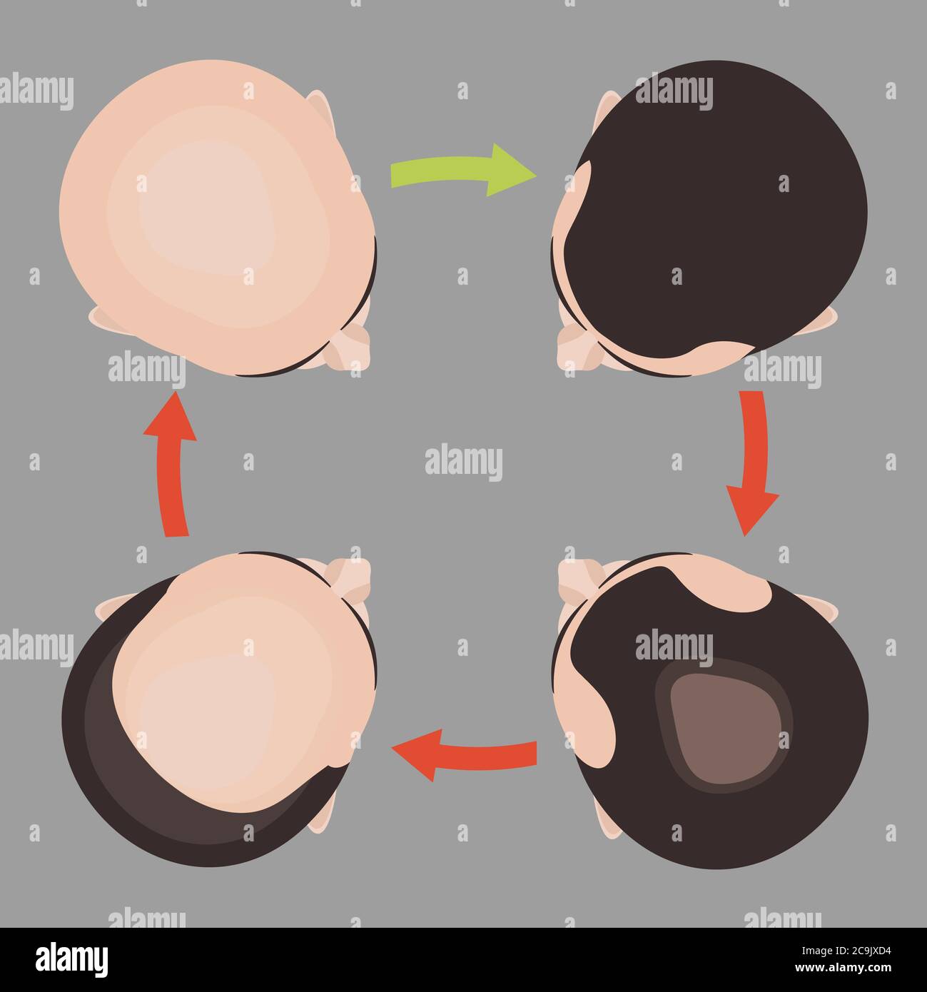 Hair loss stages in men, illustration. Stock Photo