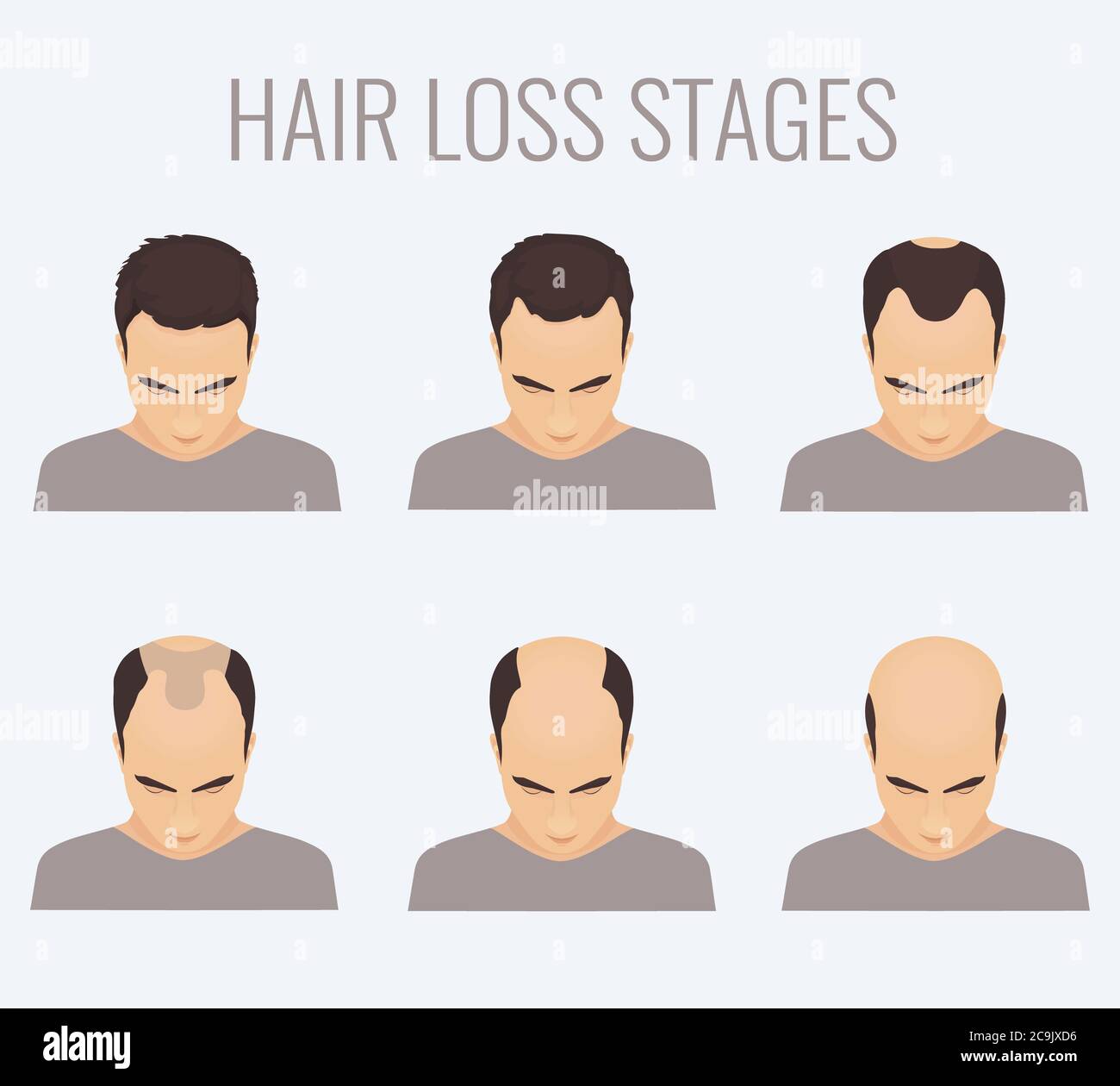 Male-pattern baldness stages, illustration Stock Photo - Alamy