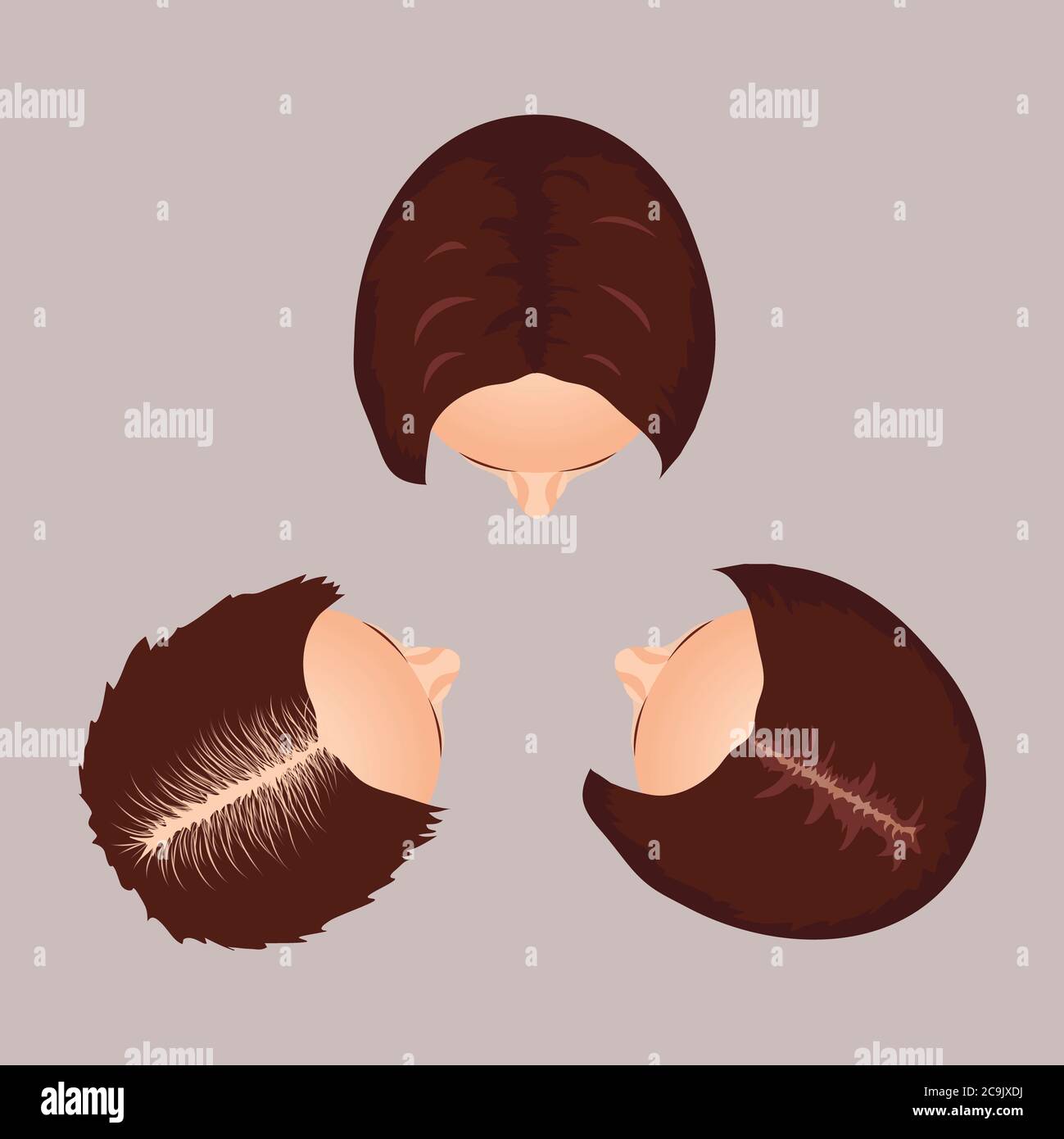 Female hair loss stages, illustration. Stock Photo