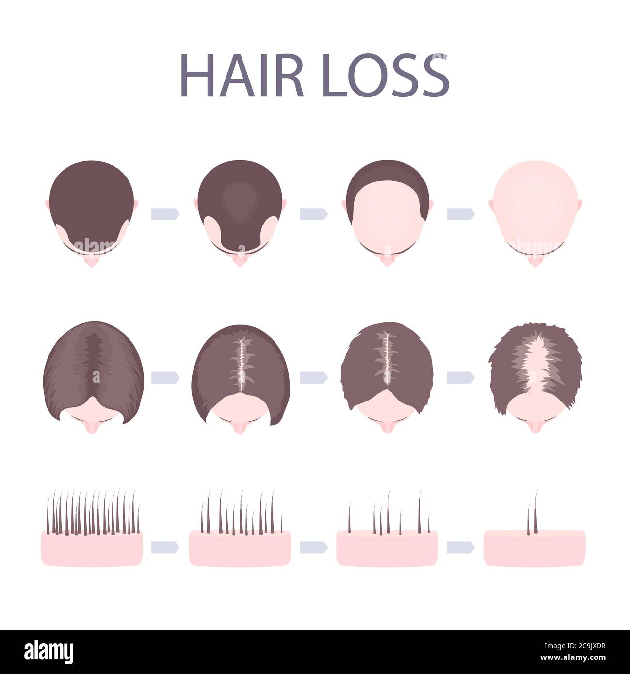 Male and female hair loss stages, illustration. Stock Photo