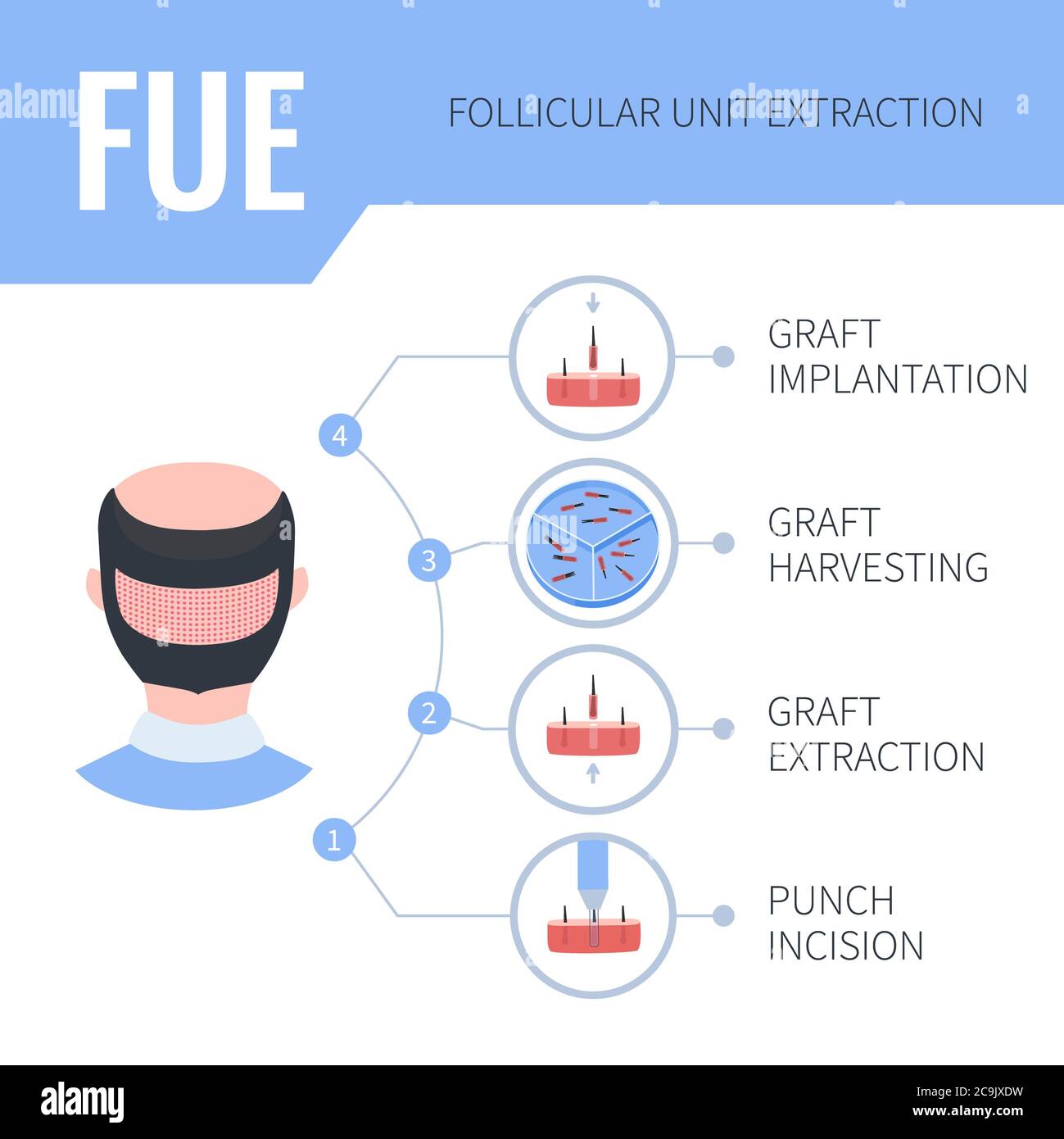 Follicular unit extraction (FUE) hair transplantation in men, illustration. Stock Photo