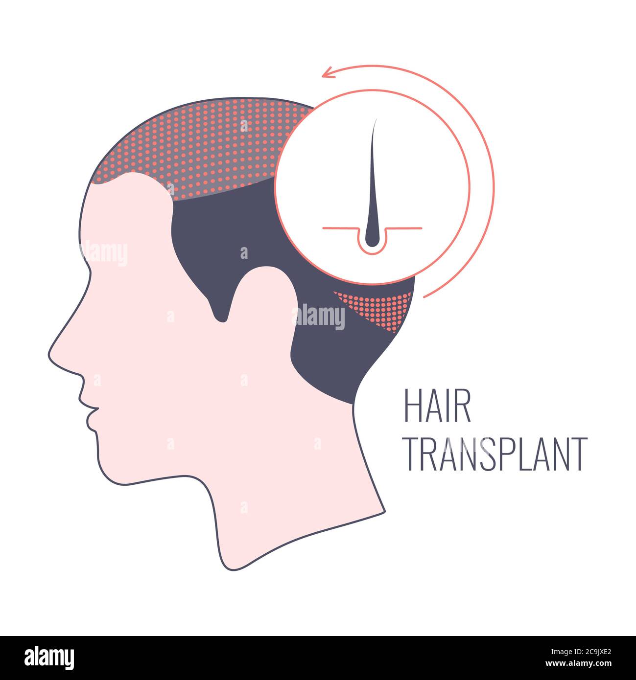 Hair Transplantation In Women, Conceptual Illustration Stock Photo - Alamy