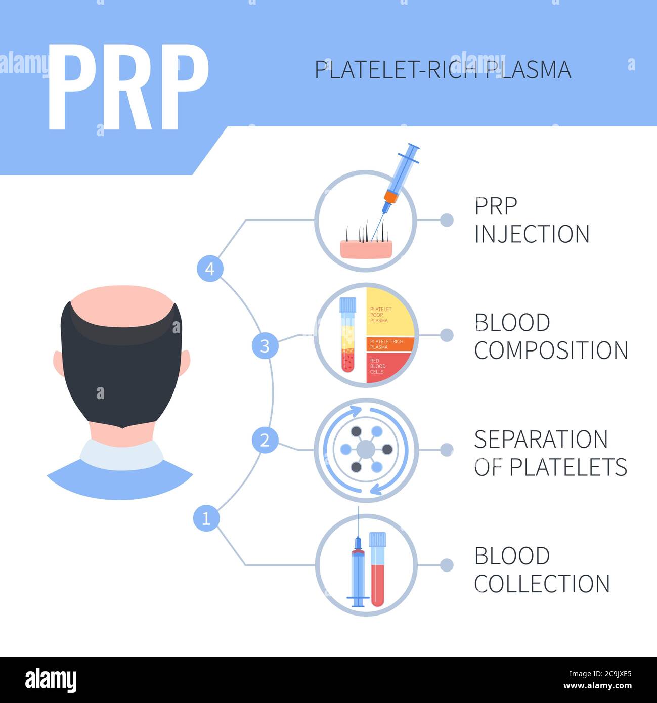 Platelet-rich plasma (PRP) hair regrowth therapy in men, illustration. Stock Photo