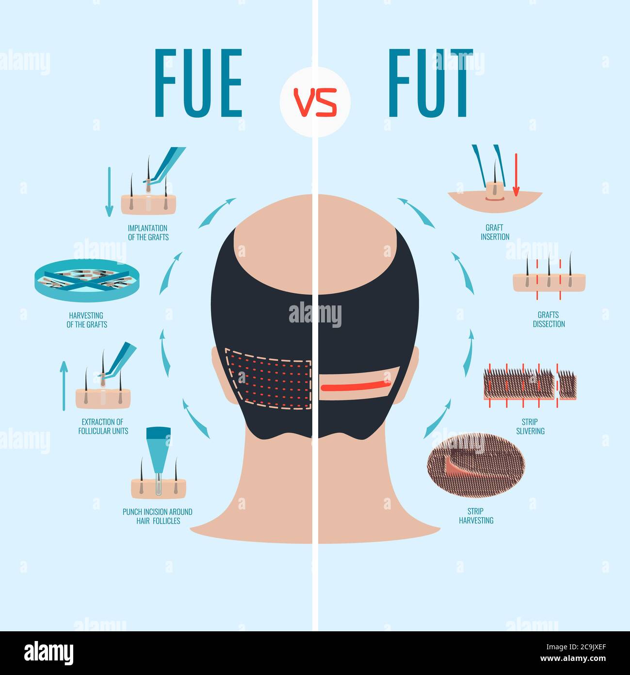 Follicular unit extraction (FUE) and follicular unit transplantation (FUT) hair loss treatments comparison, illustration . Stock Photo