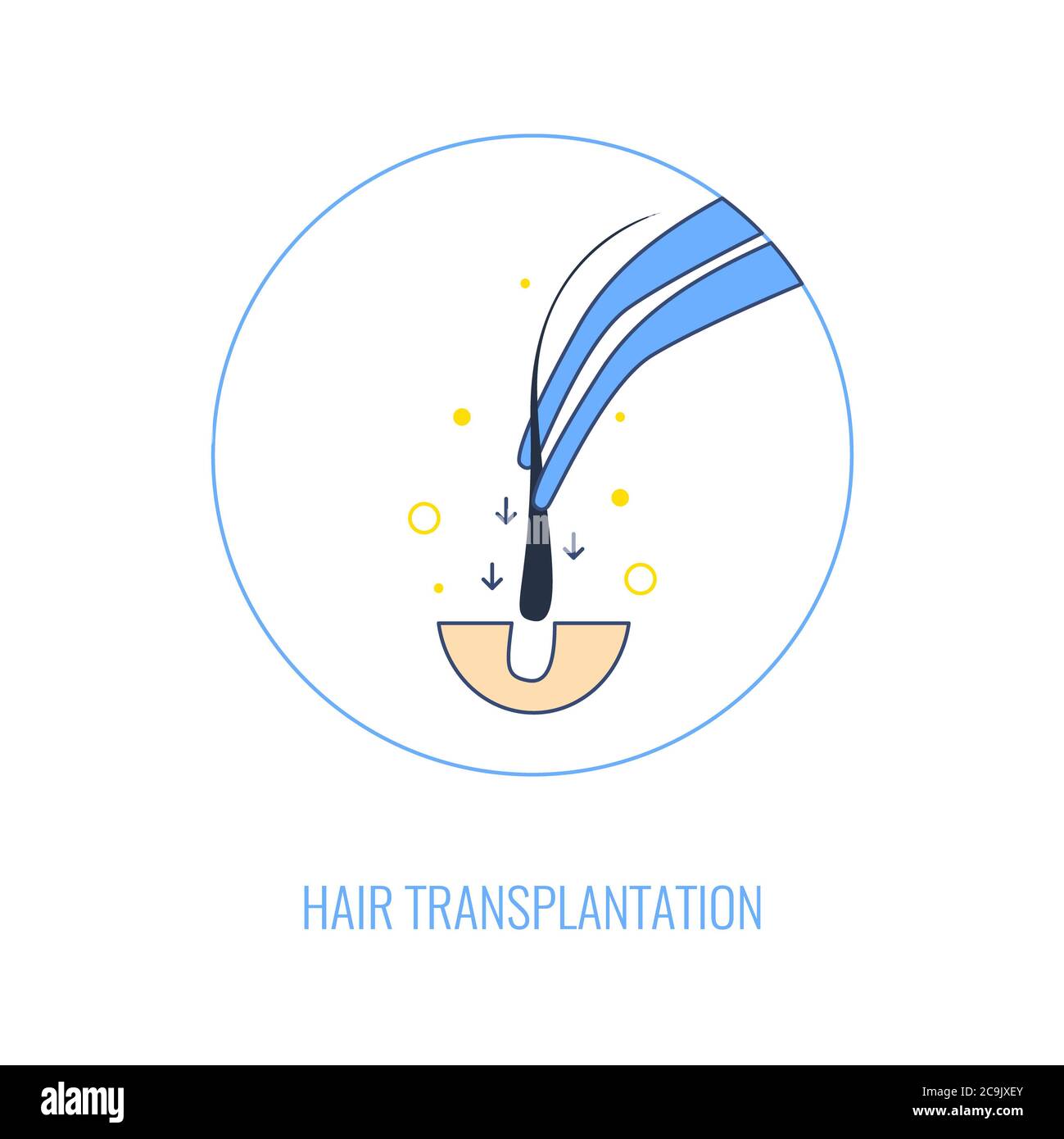 Hair transplant procedure, illustration. Stock Photo