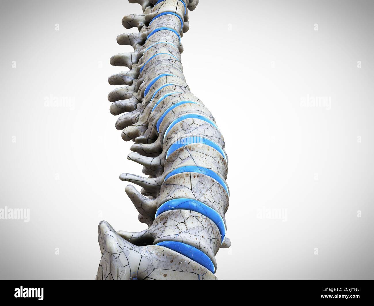 Broken spine, illustration. Stock Photo