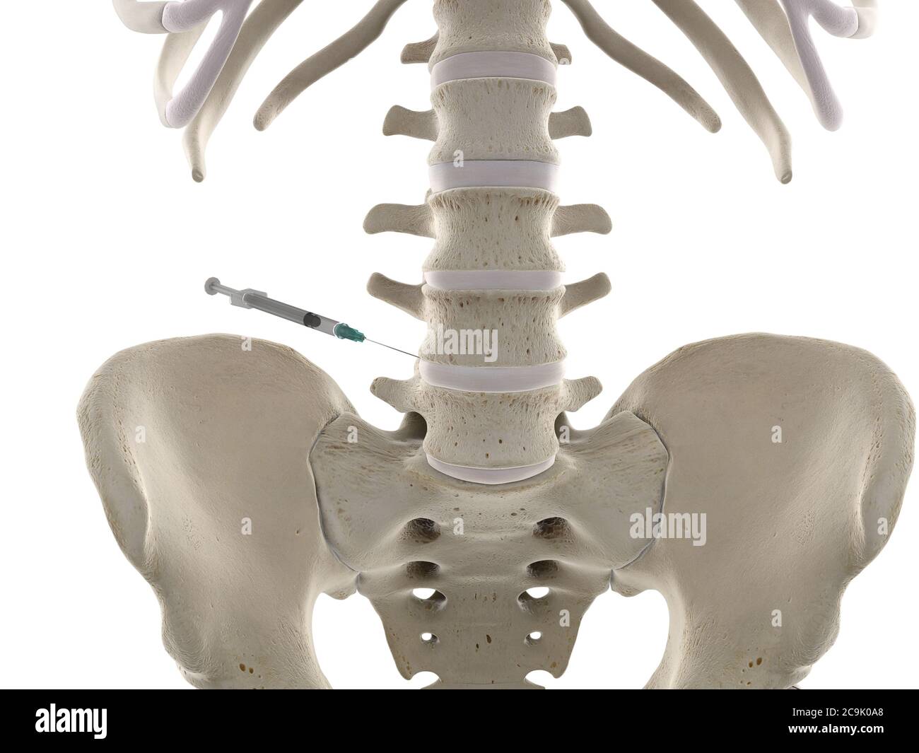 Lumbar spine injection, illustration. Stock Photo