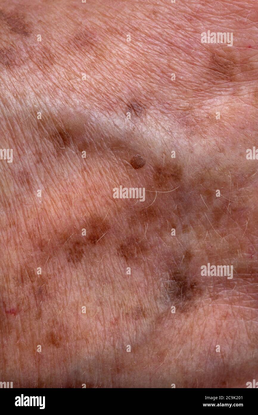 Sun Spots Skin High Resolution Stock Photography And Images Alamy Sun Spots Skin High Resolution Stock Photography And Images Alamy