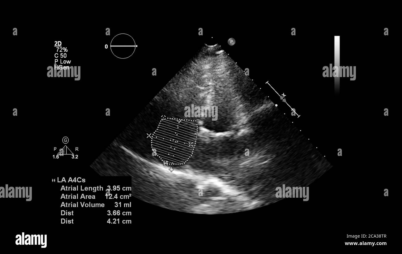 Image of the heart in gray-scale mode during transesophageal ultrasound ...